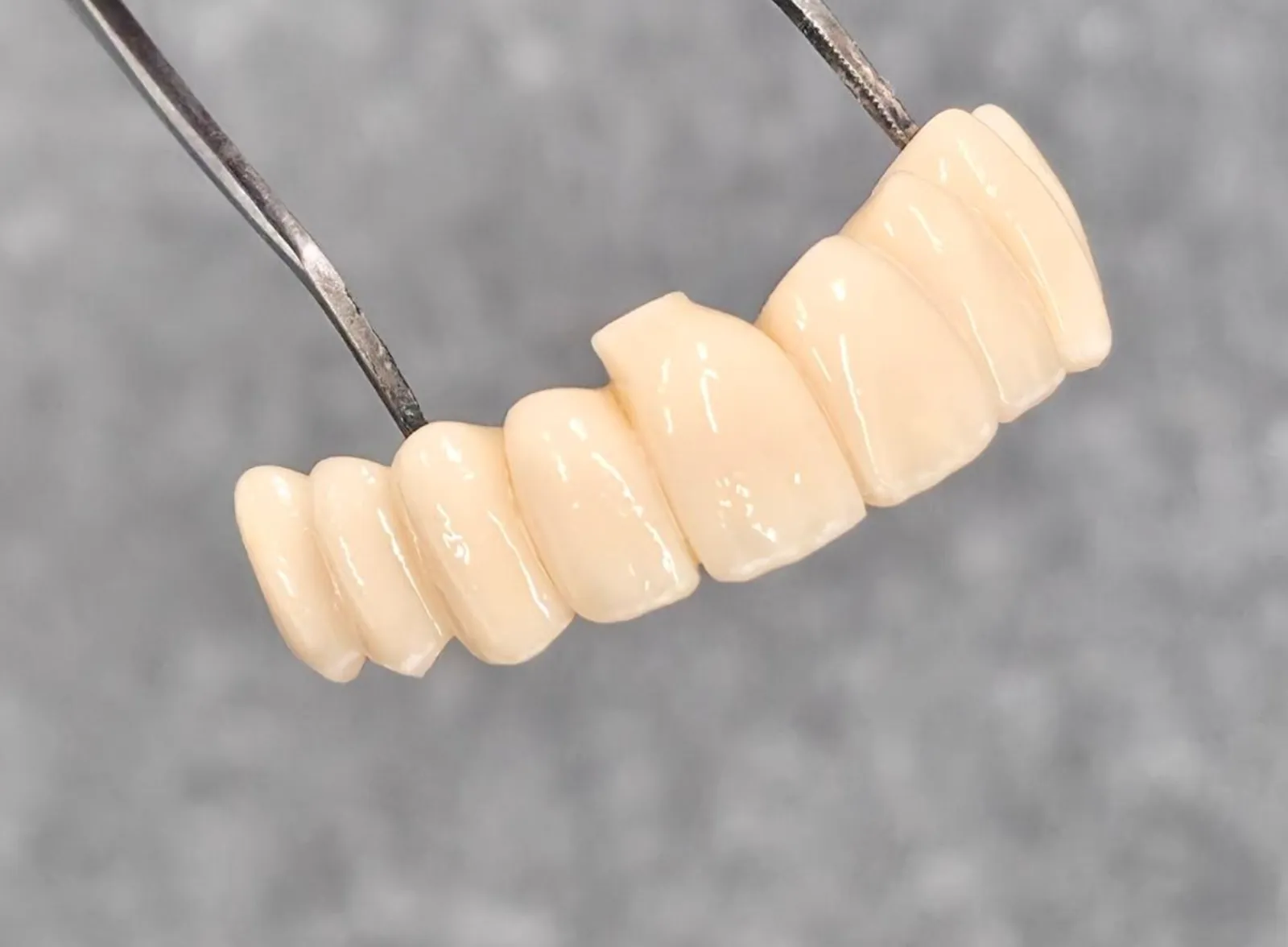 Anterior bridge held in tweezers at the bench
