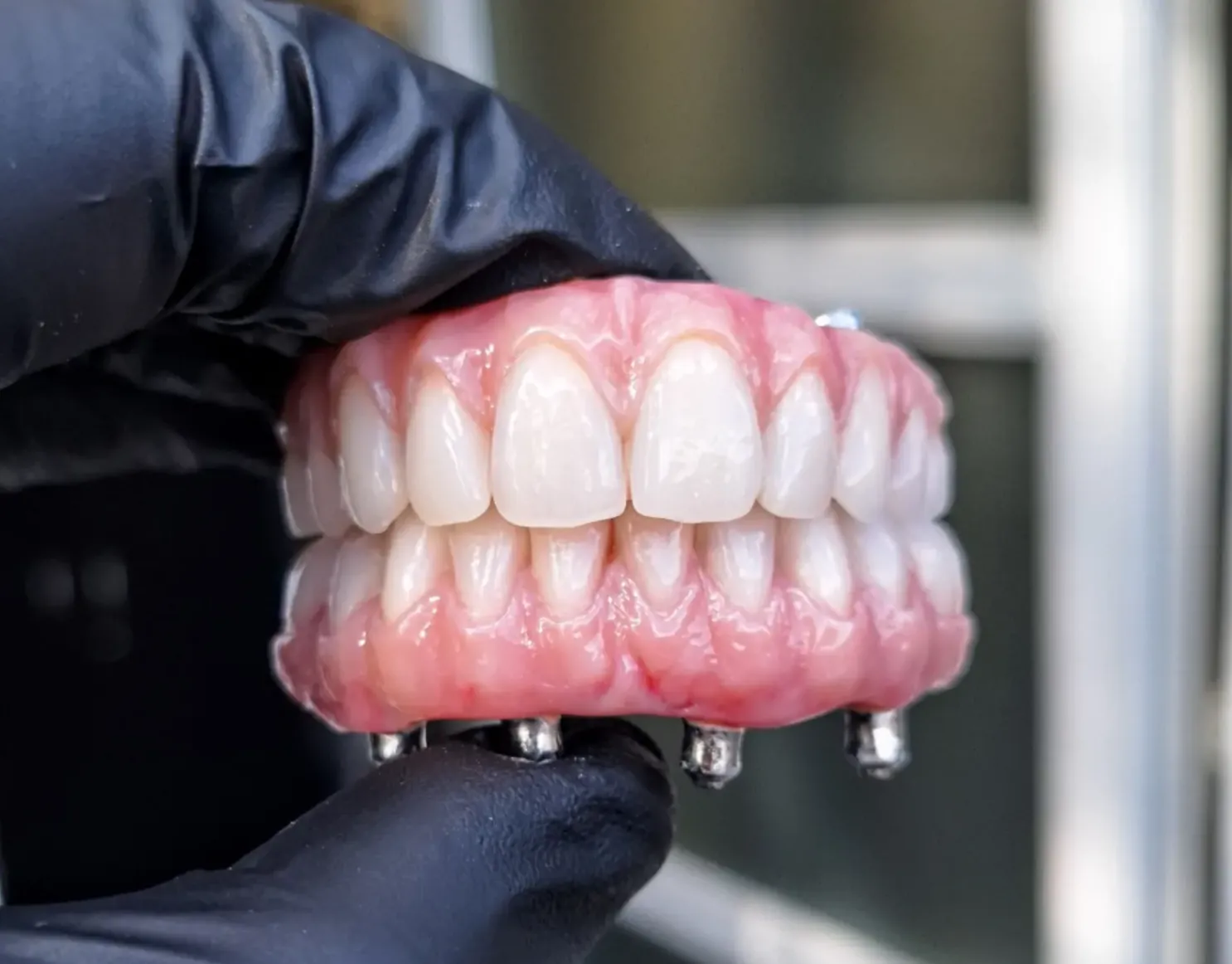 Finished full-arch implant bridge, stained, glazed and gum-tinted