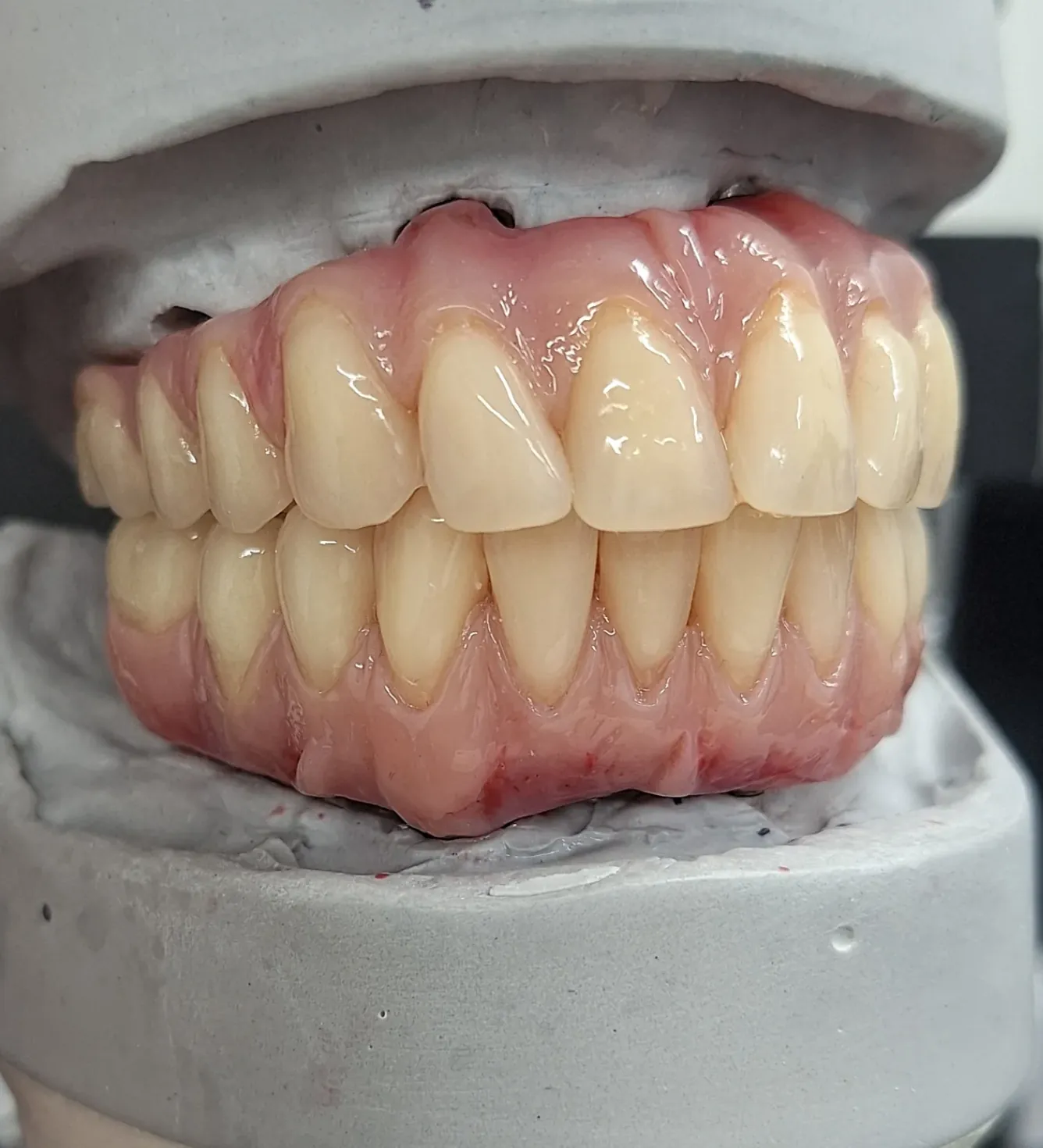 Full arch case on the model, hand-finished at the bench
